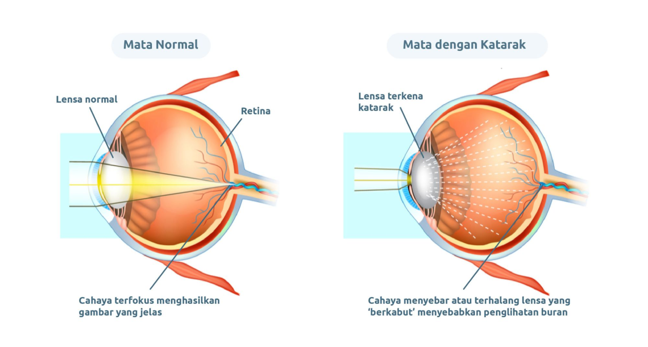 Mata Normal vs Katarak
